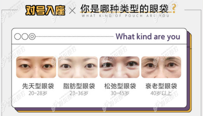 你是哪種類型的眼袋 你是哪種類型的眼袋