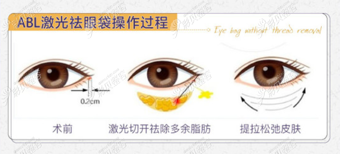 ABL激光去眼袋手術(shù)過程 ABL激光去眼袋手術(shù)過程