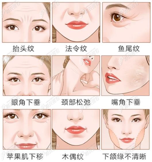 拉皮手術(shù)適合的人群 拉皮手術(shù)適合的人群
