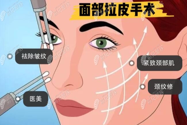 面部筋膜懸吊提升術(shù)