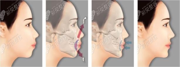 30歲輕微骨性凸嘴做矯正可以用隱適美嗎,聽說正畸價格2萬五