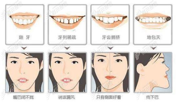輕微齒性齙牙加深覆蓋戴隱適美多少錢,矯正后顴骨會降低嗎