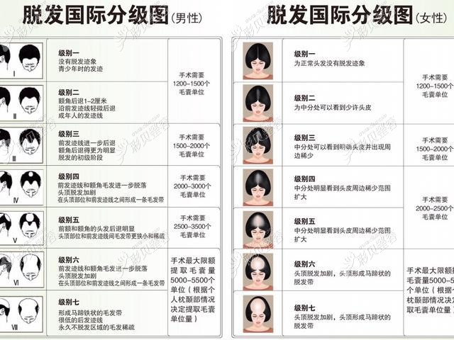 大麥微針植發(fā)毛囊數(shù)量影響植發(fā)價(jià)格 大麥微針植發(fā)毛囊數(shù)量影響植發(fā)價(jià)格
