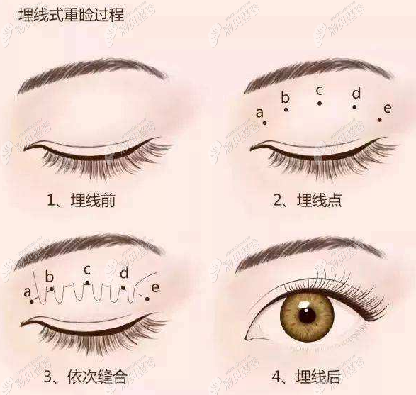 咨詢上海哪些醫(yī)院做埋線雙眼皮好,非公辦醫(yī)院做完會(huì)留疤嗎