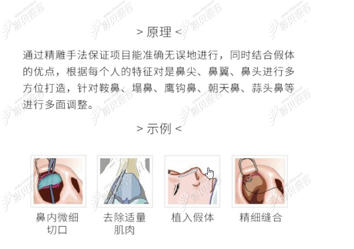廣元市硅膠假體隆鼻價格表，進口假體比國產(chǎn)假體貴那么多