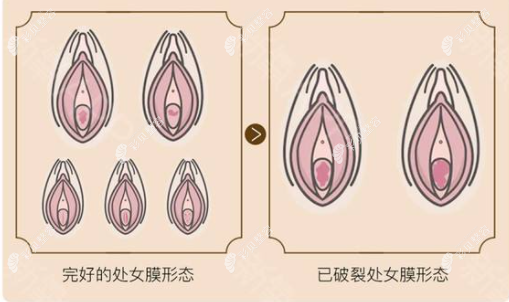 梅州曙光整形醫(yī)院處女膜修復(fù)的價(jià)格，不預(yù)約能當(dāng)天做么？