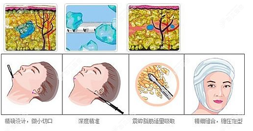 面部吸脂手術(shù)過(guò)程 面部吸脂手術(shù)過(guò)程
