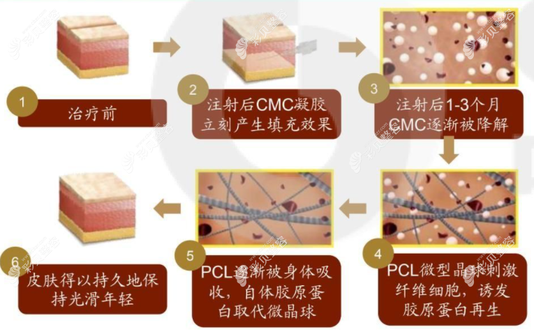 伊妍仕少女針注射后作用機制 伊妍仕少女針注射后作用機制
