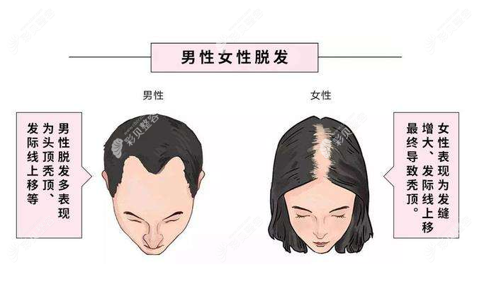 女生用米諾地爾的經(jīng)歷講述用米諾防脫生發(fā)的功效和副作用