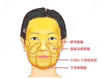 嘉興曙光整形范萌知醫(yī)生做面部吸脂好嗎