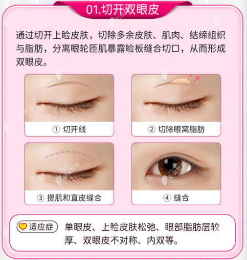 泰安鑫美武峰醫(yī)生做切開雙眼皮的操作過程 泰安鑫美武峰醫(yī)生做切開雙眼皮的操作過程