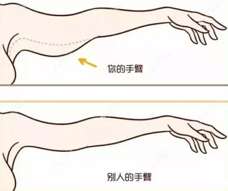 手臂吸脂多久能變細(xì)?親身分享做手臂吸脂后變細(xì)的時(shí)間過程