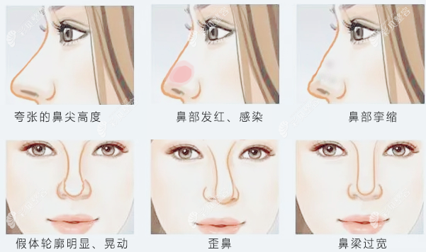 張?jiān)洪L(zhǎng)可以修復(fù)的鼻子
