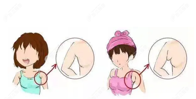 副乳切除手術(shù)幾天能恢復(fù)正常？恢復(fù)好了以后還會(huì)不會(huì)在長(zhǎng)