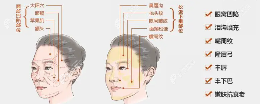中下面部脂肪填充多了怎么辦?并且脂肪填充后臉頰還下垂了