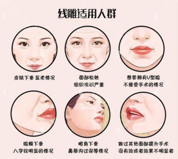 埋線提升適合的人群 埋線提升適合的人群