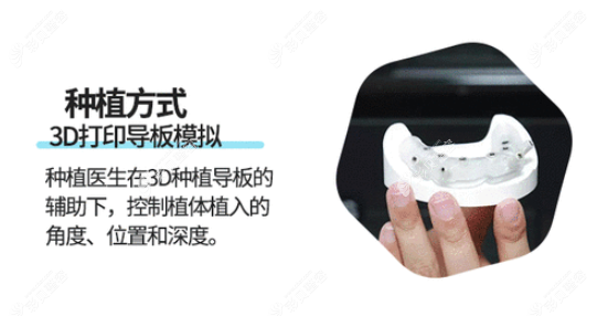 牙博士3d打印導板的優(yōu)勢