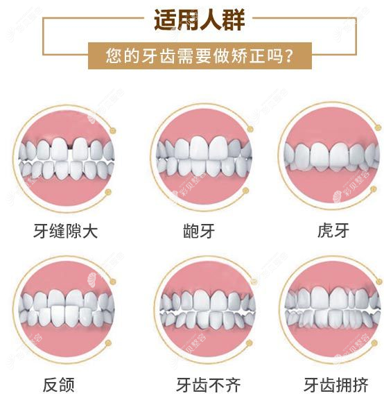 朝陽牙博士能正畸的牙齒類型