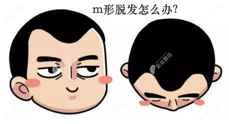 m形脫發(fā)怎么辦 m形脫發(fā)怎么辦