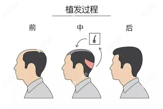 我植發(fā)第1天、第2天、第7天、3個(gè)月及9個(gè)月的植發(fā)經(jīng)歷分享