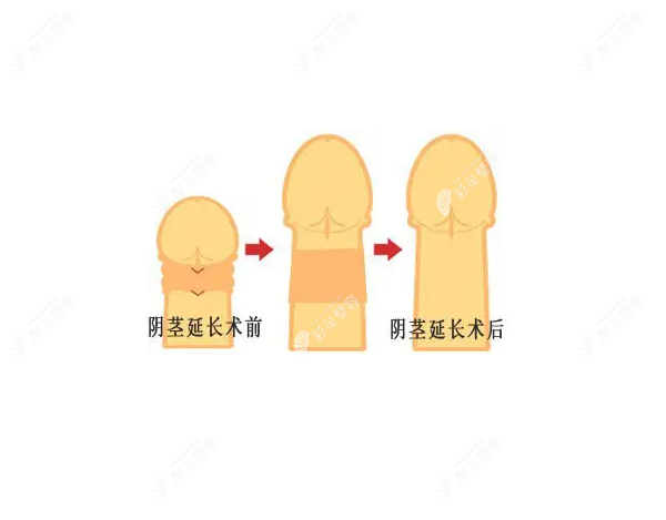 陰莖延長(zhǎng)術(shù)價(jià)格一覽：看男性做陰莖增長(zhǎng)手術(shù)一般要多少錢