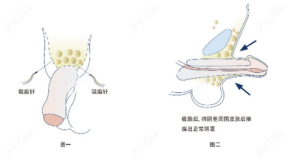 吸脂陰莖延長(zhǎng)術(shù)費(fèi)用 吸脂陰莖延長(zhǎng)術(shù)費(fèi)用