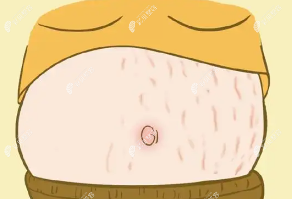 腰腹環(huán)吸后懷孕會(huì)增加長(zhǎng)妊娠紋的可能嗎？