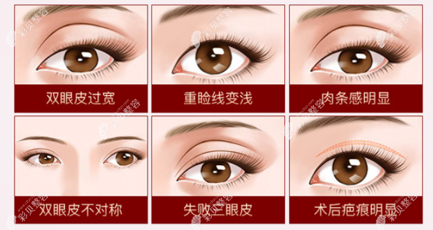雙眼皮失敗的癥狀