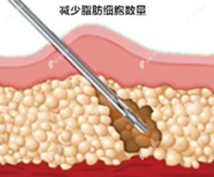 吸脂的作用 吸脂的作用