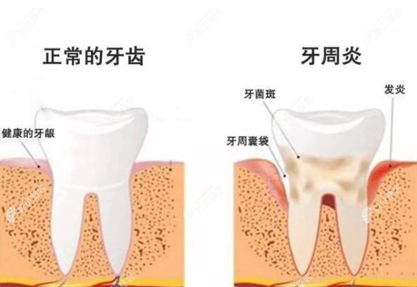 劉晨醫(yī)生治療口腔牙周炎經(jīng)驗比較豐富 劉晨醫(yī)生治療口腔牙周炎經(jīng)驗比較豐富