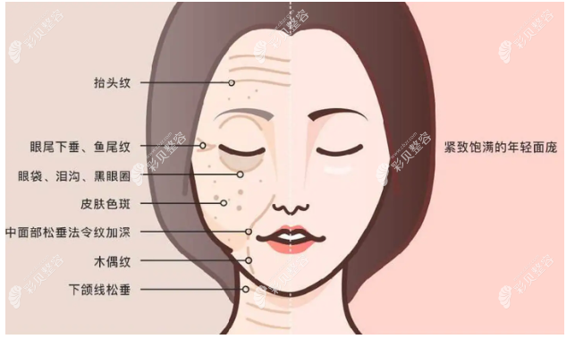 密速提、微拉美、速拉美面部拉皮技術的優(yōu)缺點大盤點啦
