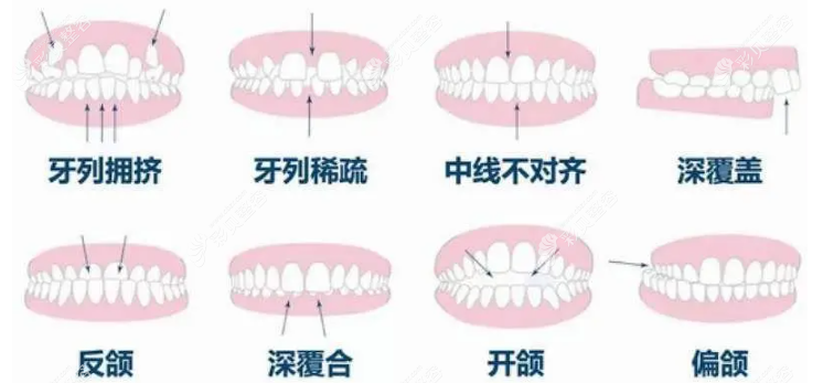 什么樣的牙齒需要進(jìn)行矯正 什么樣的牙齒需要進(jìn)行矯正