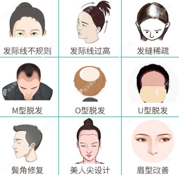 植發(fā)手術后恢復期大概要多久?是三個月,六個月還是一年恢復