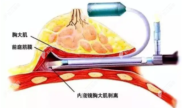 昆明博美周勇醫(yī)生做內(nèi)窺鏡豐胸技術(shù)怎么樣 昆明博美周勇醫(yī)生做內(nèi)窺鏡豐胸技術(shù)怎么樣