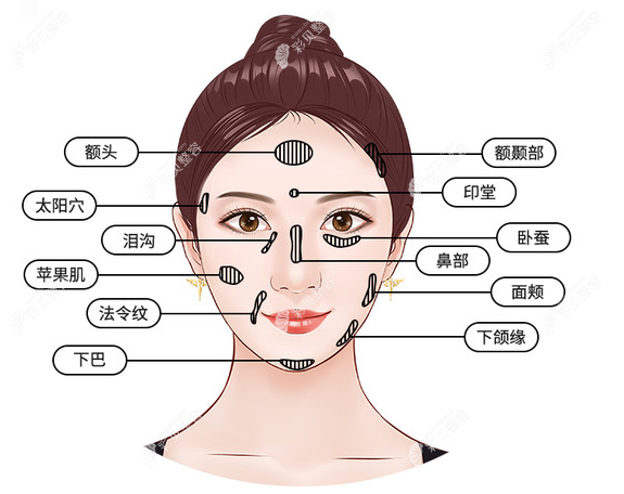 自體脂肪豐額頭有什么好處,不僅能去抬頭紋,還能...