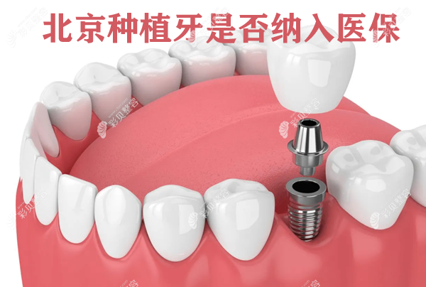 北京種植牙是否已納入醫(yī) 保政策 北京種植牙是否已納入醫(yī) 保政策