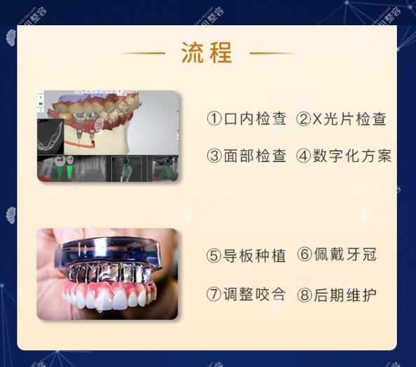 數(shù)字化種植牙流程和步驟