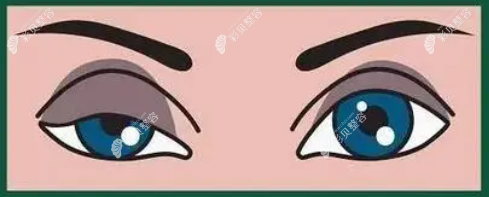 提眉手術(shù)兩個月后眼睛一大一小,能修復(fù)嗎?有沒好的醫(yī)生推薦