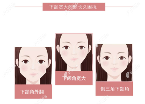 下頜角截骨手術適合人群有哪些 下頜角截骨手術適合人群有哪些