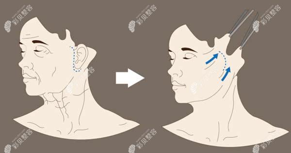 廣州韓妃整形醫(yī)院面部拉皮除皺前后對比圖 廣州韓妃整形醫(yī)院面部拉皮除皺前后對比圖