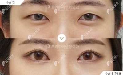 韓國普瑞美醫(yī)院全切雙眼皮+開內(nèi)眼角+上眼瞼去皮去脂真人實例