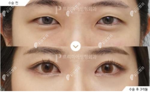 韓國普瑞美整形醫(yī)院崔恒碩質(zhì)樸愛做眼睛怎么樣 韓國普瑞美整形醫(yī)院崔恒碩質(zhì)樸愛做眼睛怎么樣