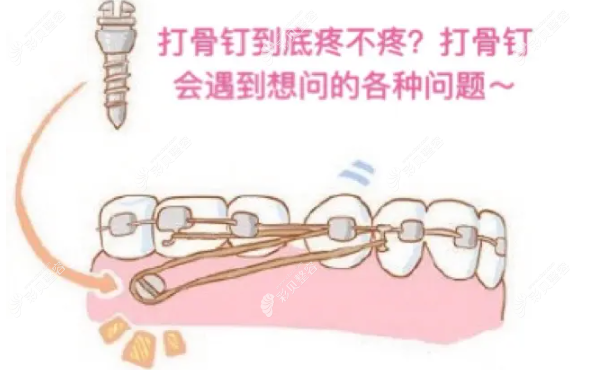 牙齒矯正要打骨釘嗎?骨釘?shù)淖饔檬鞘裁?等問題詳細(xì)解答