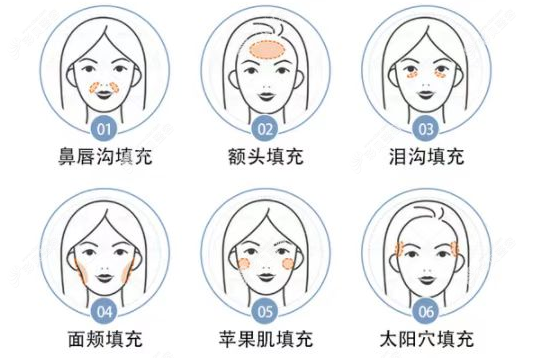 脂肪填充臉部全麻好還是局麻好,局麻可以忍受嗎,疼不疼