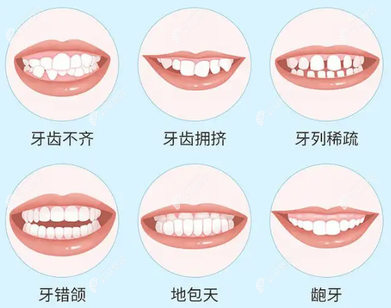 二次矯正比第1次更貴嗎？那二次正畸的費用誰來承擔(dān)？