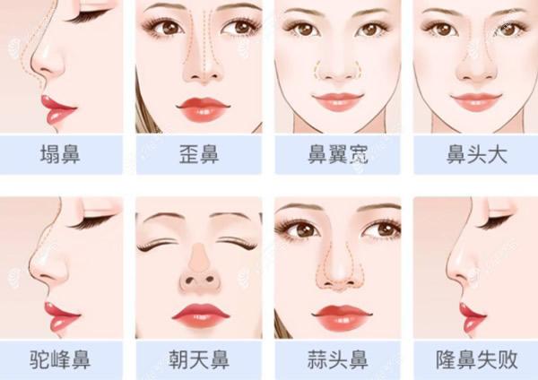 邯鄲百禾智美醫(yī)院李冠英醫(yī)生做鼻子怎么樣 邯鄲百禾智美醫(yī)院李冠英醫(yī)生做鼻子怎么樣