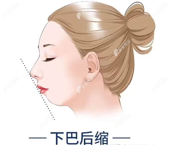 下巴后縮矯正手術(shù)多少錢(qián)一次?下巴截骨3萬(wàn)起,假體墊下巴4800+
