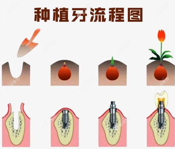種植牙過程圖解