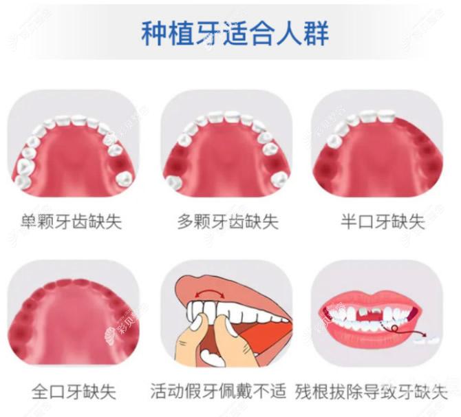 漳州仰德醫(yī)院種植牙科普