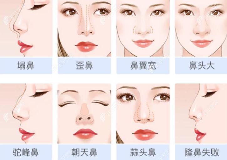 漳州仰德醫(yī)院科普鼻綜合適合的人群